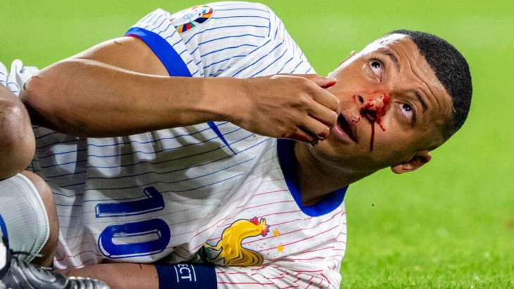 Mbappé-nez-Danso-Euro-2024-Autriche-jpg